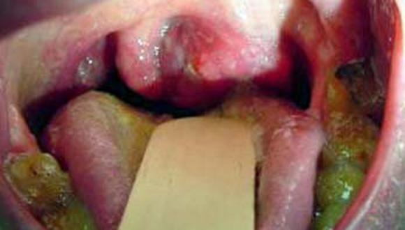 imagenes de cancer de garganta