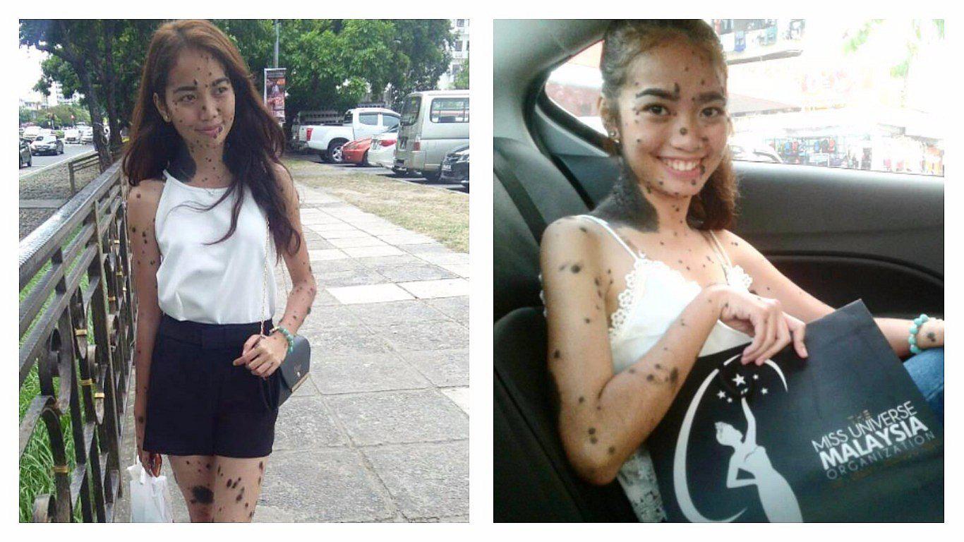 Miss Universo: joven con extraña enfermedad busca la corona