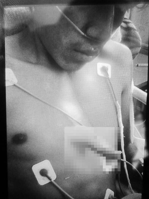 Palo le atraviesa pecho y sobrevive