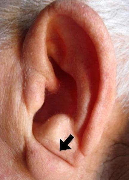 Un pliegue en tu oreja te advierte del riesgo de padecer un infarto
