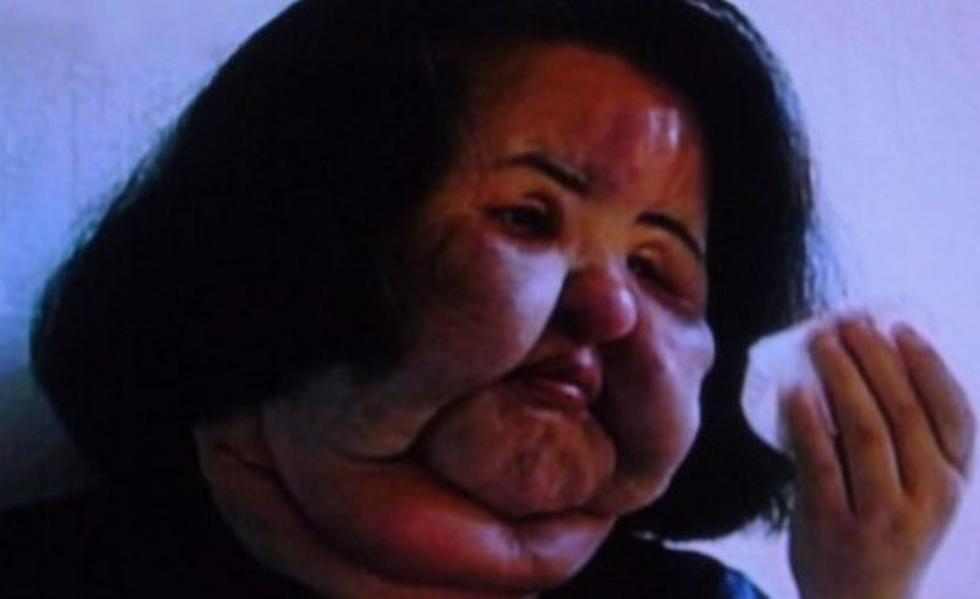 Así quedó exmodelo por obsesión a las cirugías