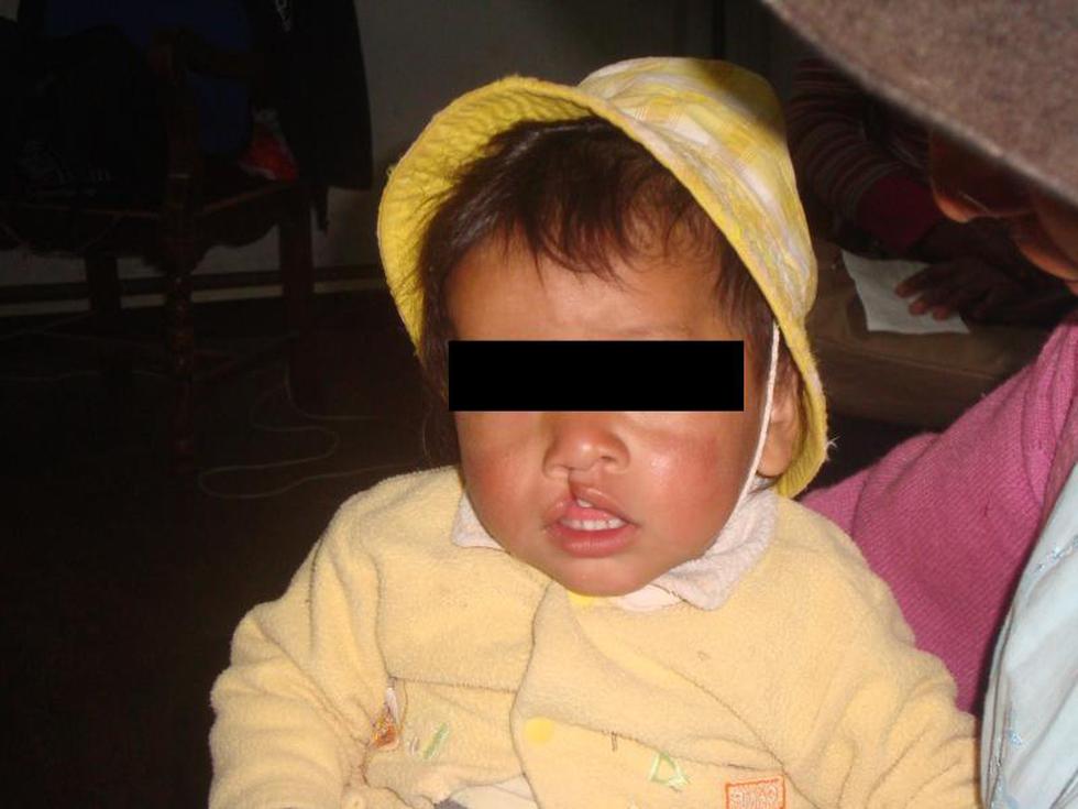Beneficencia desarrolla campaña de operación de labio leporino