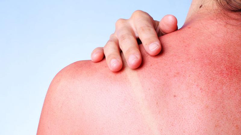 Conoce las enfermedades más comunes en verano y cómo prevenirlas