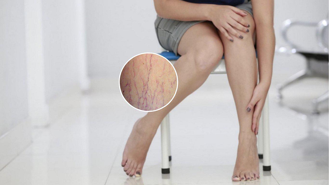 Diez consejos para evitar la temprana aparición de las varices