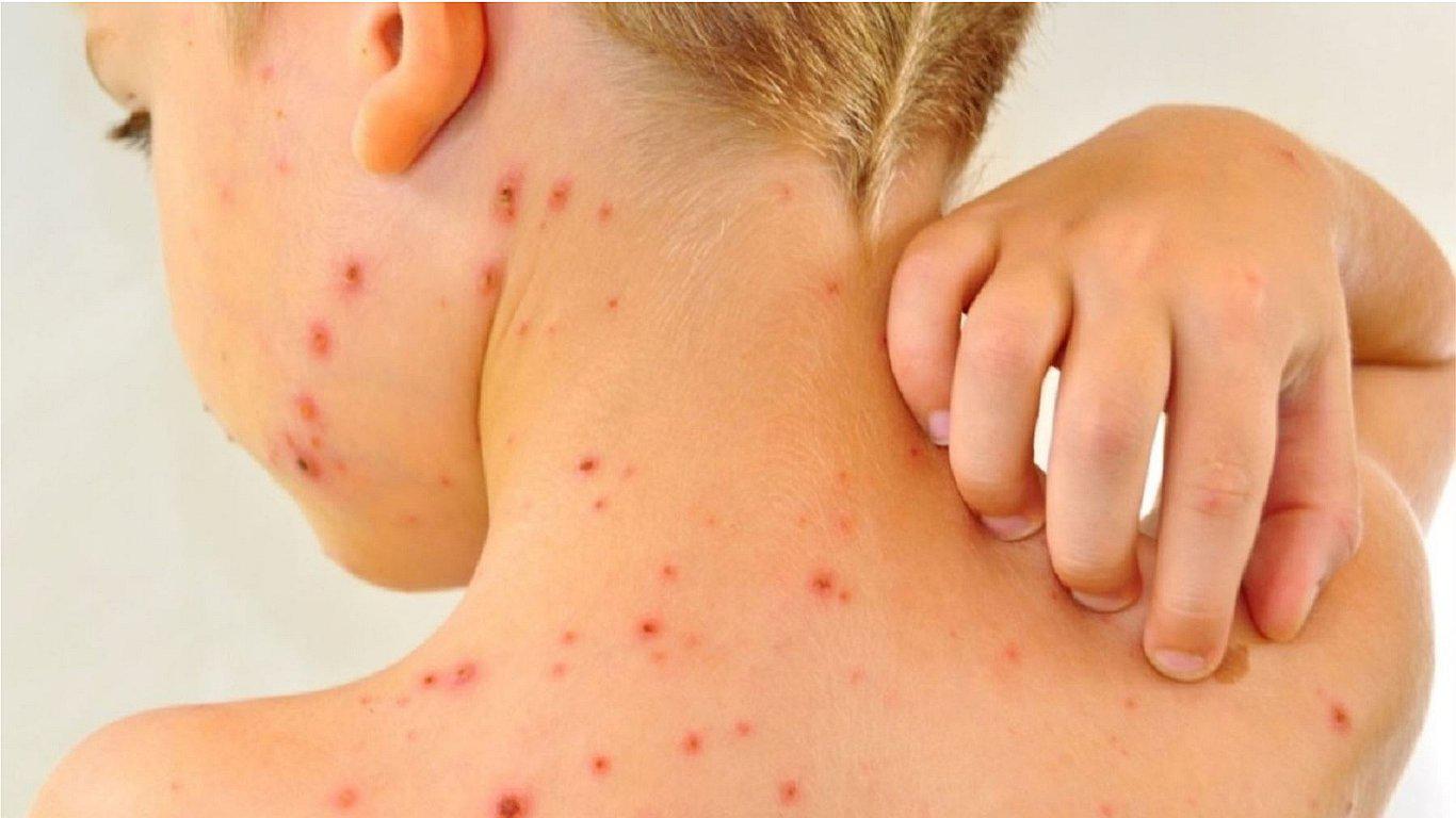 Varicela: 4 consejos para tratarla de manera correcta
