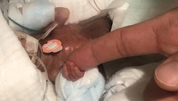 Bebé que nació con 268 gramos fue dado de alta y es considerado el más pequeño del mundo