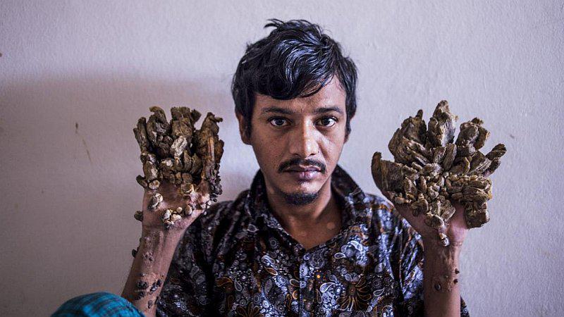 Hombre con extraña enfermedad pide que le amputen las manos 