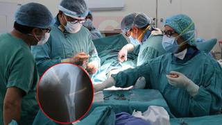 Unas 60 cirugías por fracturas al mes realizan en el hospital Carrión de Huancayo