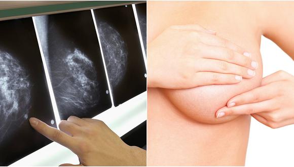 Inmunoterapia consigue eliminar el cáncer de mama en paciente con metástasis