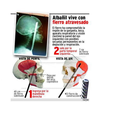 Con éxito operan y sacan varilla de cuerpo de  albañil 