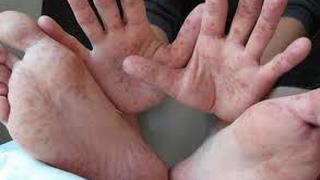 Junín: Unos 172 niños se contagian del virus de pies, manos y boca y colegios son enviados a cuarentena