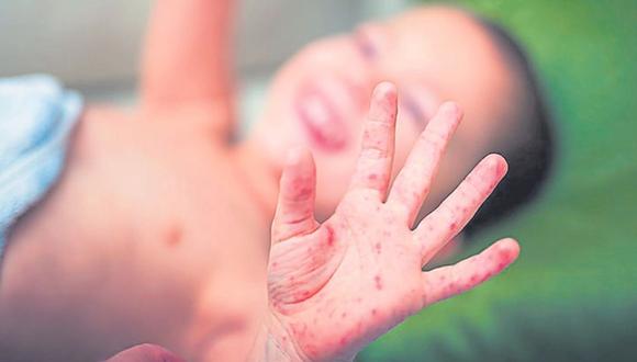 La enfermedad, que genera la erupción de ampollas en manos, boca y pies, afecta en su mayoría a los menores.