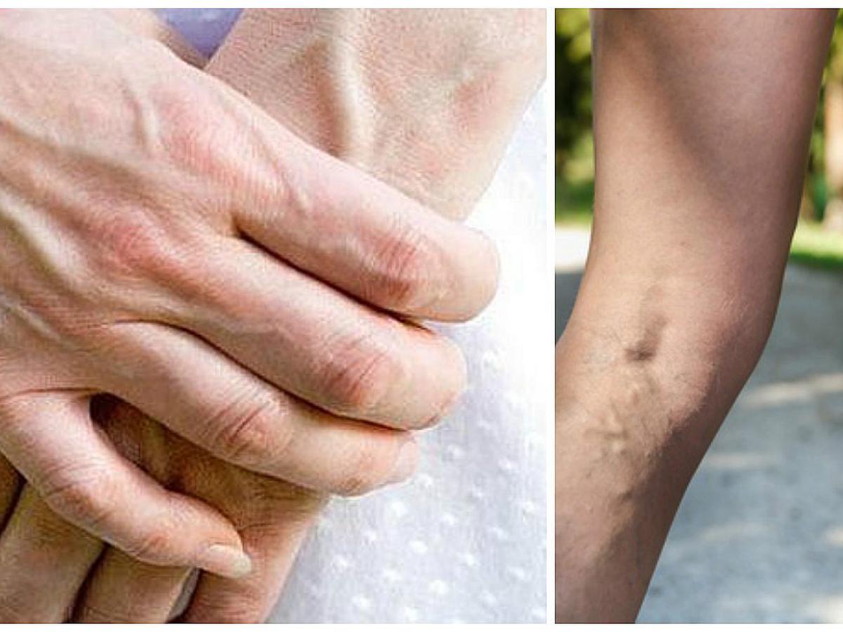 Por Que Se Marcan Las Venas En Los Brazos Salud Correo