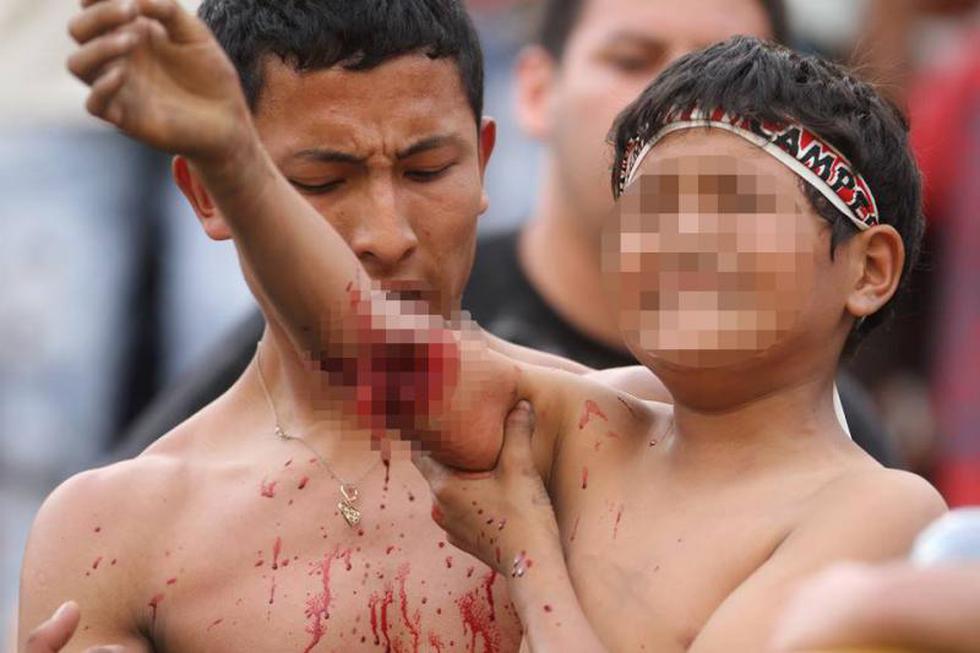 Niño resultó con seria lesión en el brazo durante celebración del título de la U