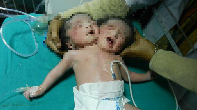 Bebé con dos cabezas nació en la India