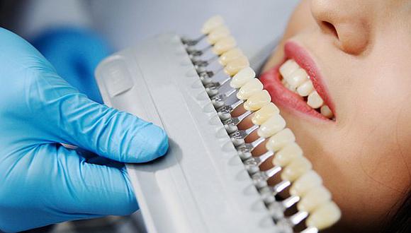 Esto es lo que debes saber antes de ponerte carillas dentales