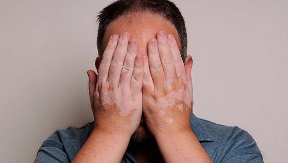 Cuidado el estrés y depresión pueden provocar vitiligo