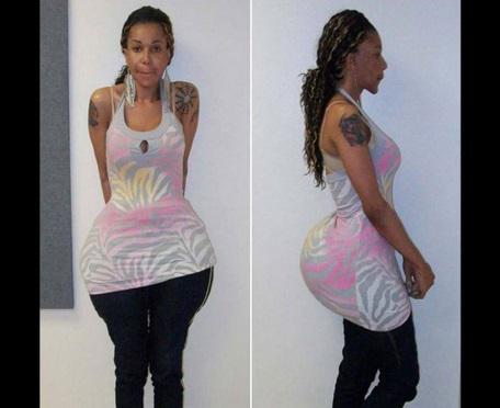 Falsa doctora inyectaba cemento en glúteos de sus pacientes