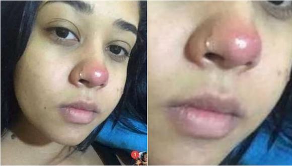 Mujer queda parapléjica tras ponerse un piercing en la nariz 