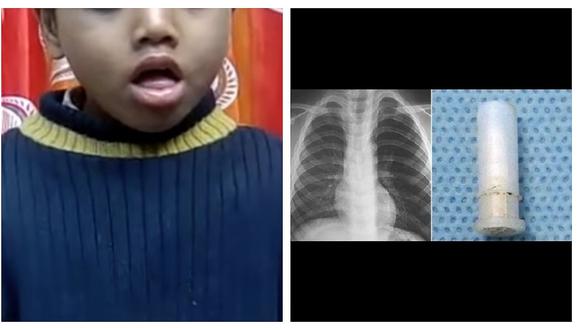 ​Niño se traga silbato y cada vez que tose emite singular sonido (VIDEO)