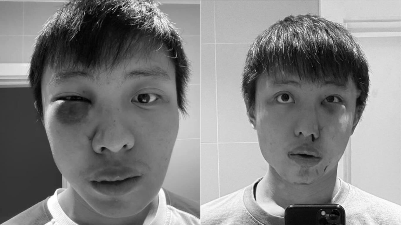 El joven publicó fotos de su rostro tras ser víctima de agresión en una calle de Londres. Foto: Facebook.