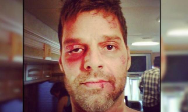 Foto de Ricky Martin golpeado asustó a fans 