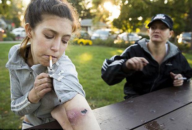 Krokodil: Así sería el tratamiento para adictos