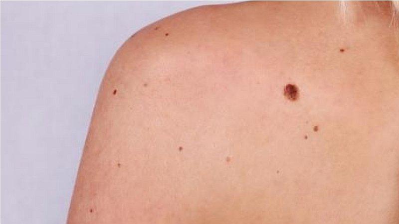 Verano 2019: Inician campaña de despistajes contra el cáncer de piel