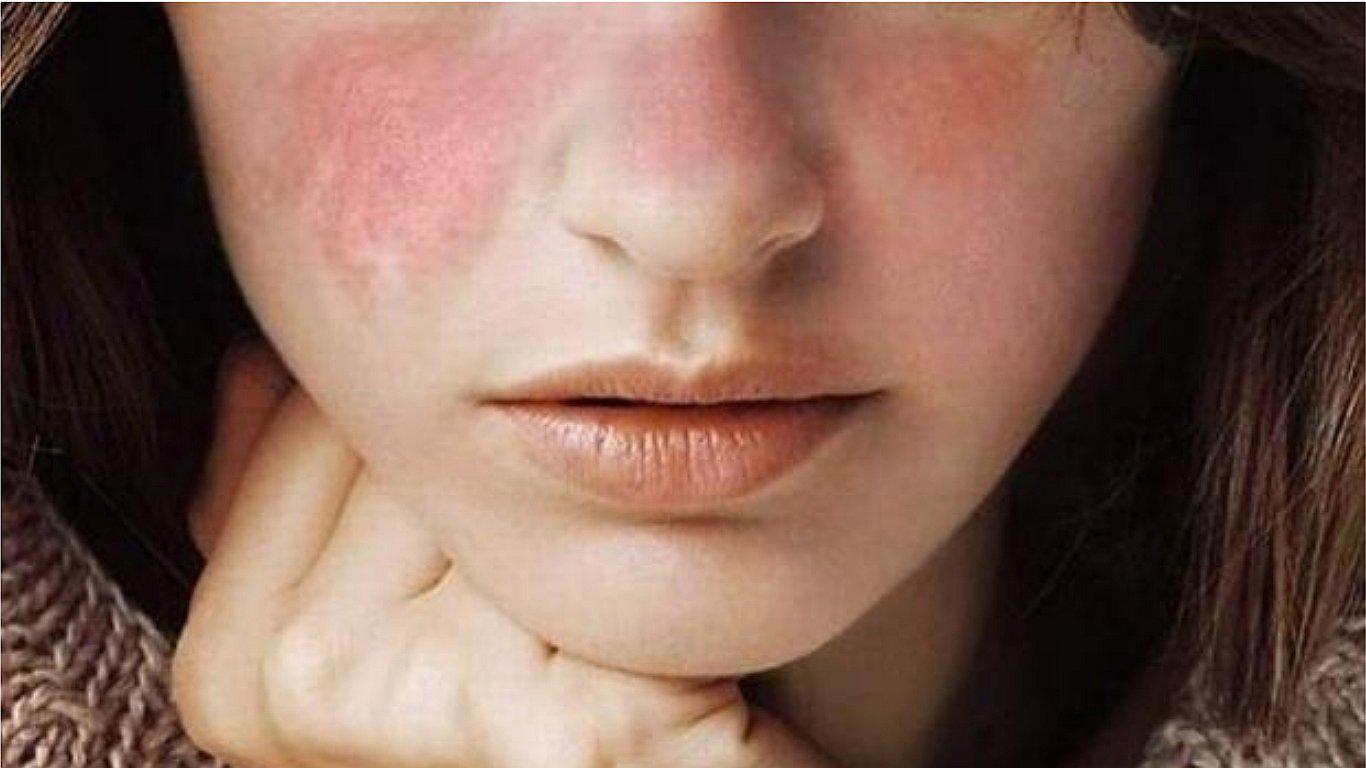 Lupus: ¿Cuáles son sus síntomas, causas y tratamiento?