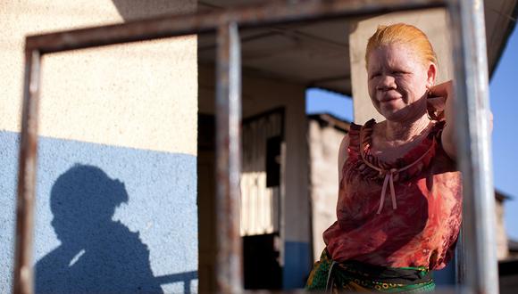 Tanzania detiene a 225 curanderos por matar a albinos para hacer brujería