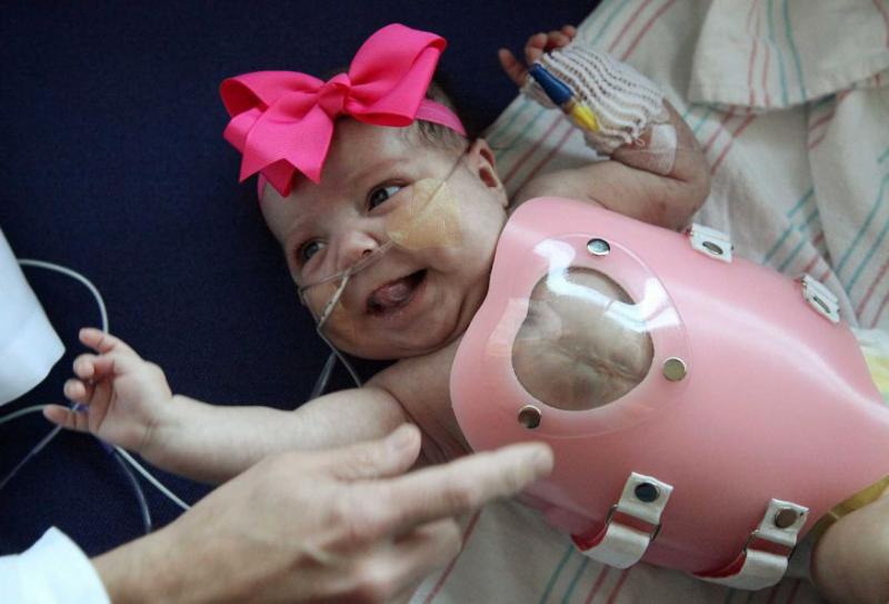 Bebé que nació con el corazón afuera fue dada de alta