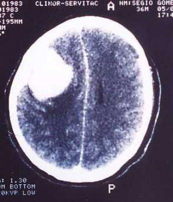 Enorme tumor aqueja a mujer