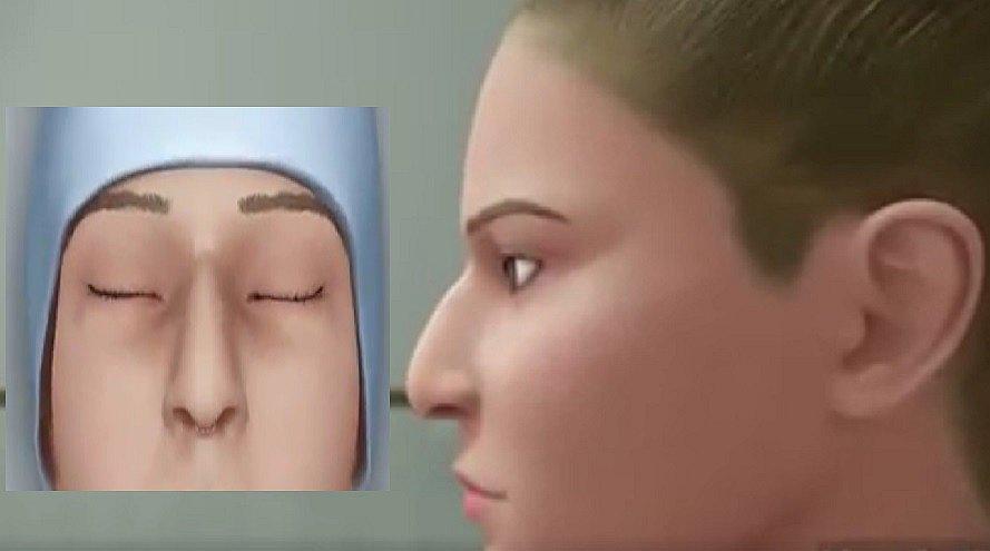 Facebook: Así se hace una rinoplastía para problemas estéticos de la nariz (VIDEO)