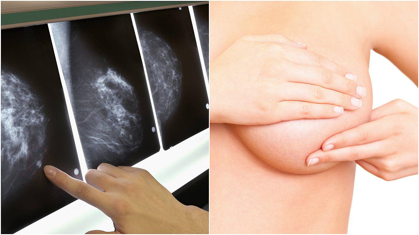 Inmunoterapia consigue eliminar el cáncer de mama en paciente con metástasis