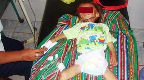 Atalaya: Niño de un año y medio muere con desnutrición crónica