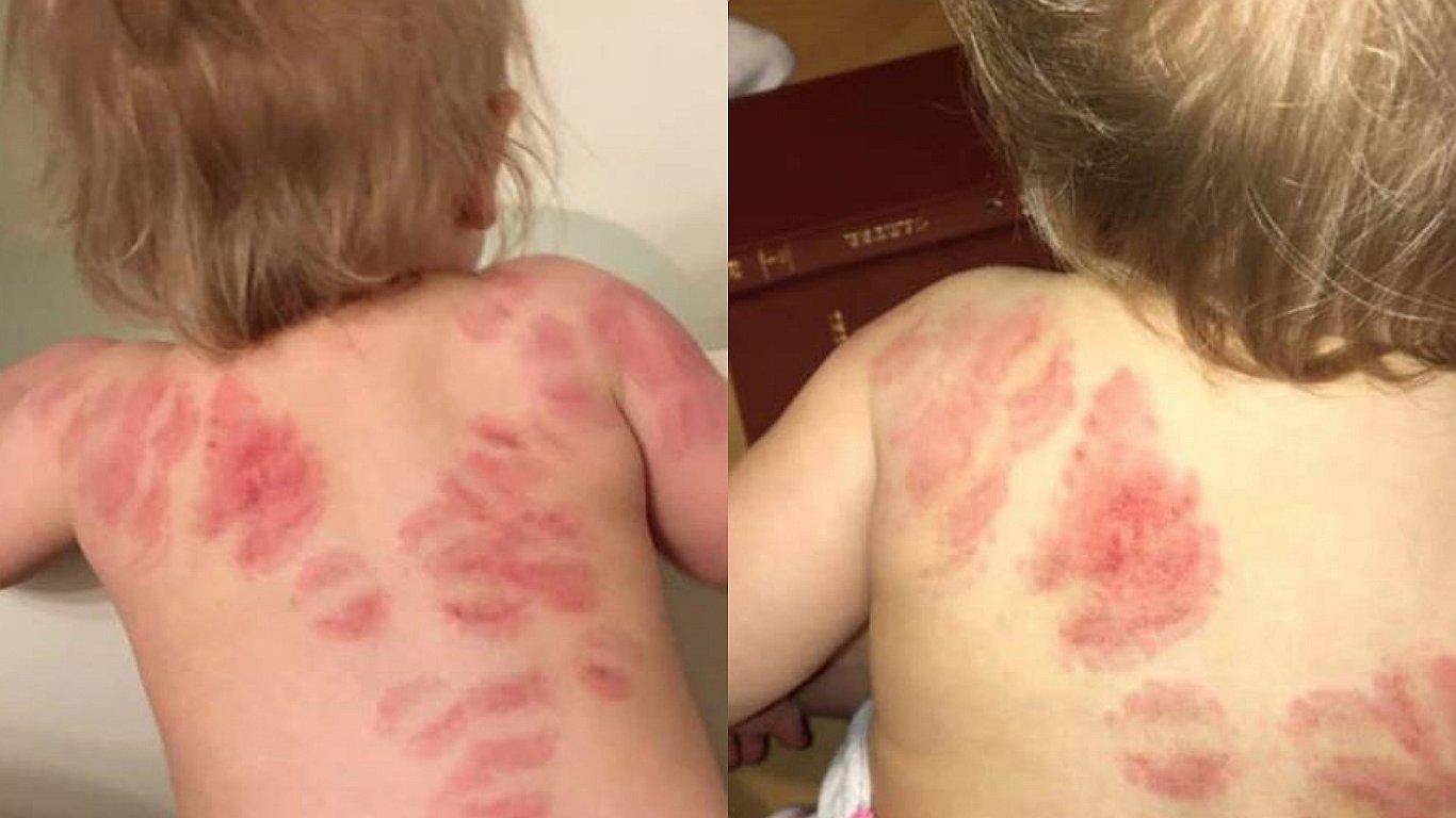 Mujer notó que su bebé había sido mordida más de 25 veces tras recogerla de la guardería