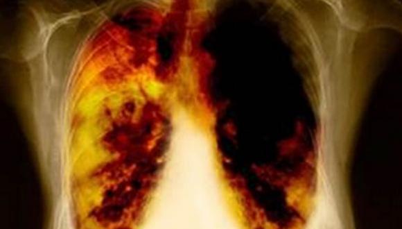 Estas son las 7 señales de advertencia de cáncer de pulmón a tener en cuenta
