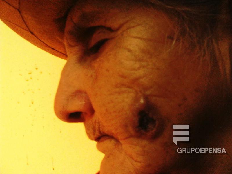 Cáncer de piel ocupa cuarto lugar en enfermedades neoplásicas