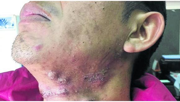 ​Casos severos de acné pueden generar quistes y abscesos