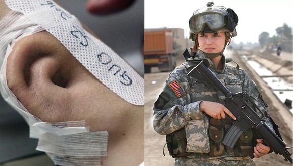 Soldado de EE.UU. pierde oreja en accidente y doctores le injertan una en el brazo
