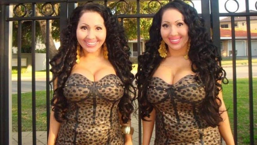 Gemelas se operan para ser idénticas y compartir novio