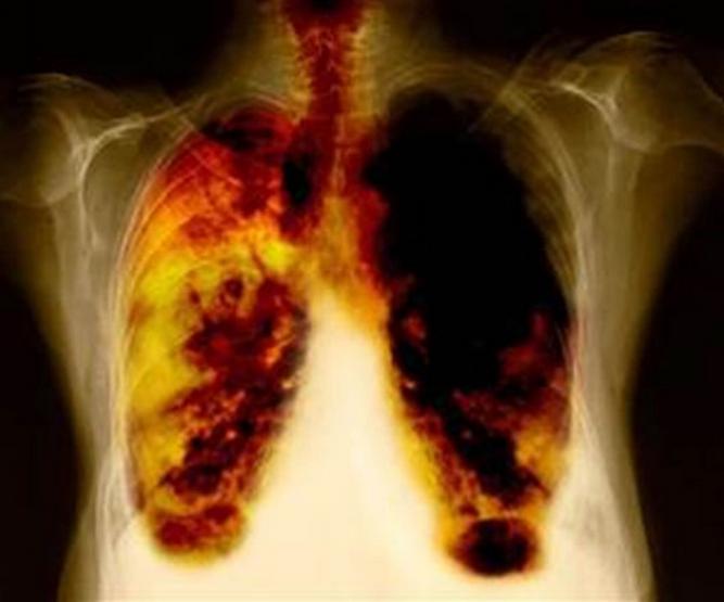 Estas son las 7 señales de advertencia de cáncer de pulmón a tener en cuenta