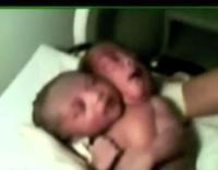 Colombia: Nace una bebé de dos cabezas