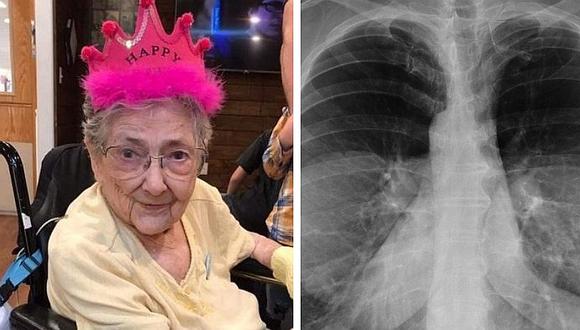 Esta mujer vivió por 99 años sin saber que sus órganos estaban invertidos