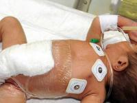 Pakistán: Operan con éxito a bebé que nació con seis piernas