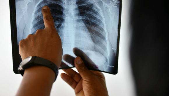 6 mil casos de Tuberculosis fueron detectados en el 2016