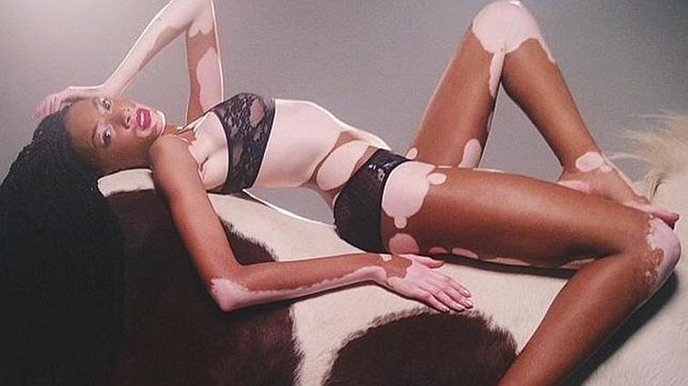 Conoce a la modelo con vitiligo que triunfa en los Estados Unidos (FOTOS)
