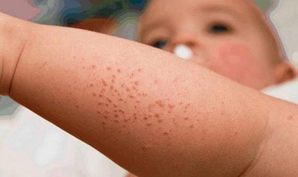 ​Sepa cómo prevenir el sarpullido en bebés durante el verano