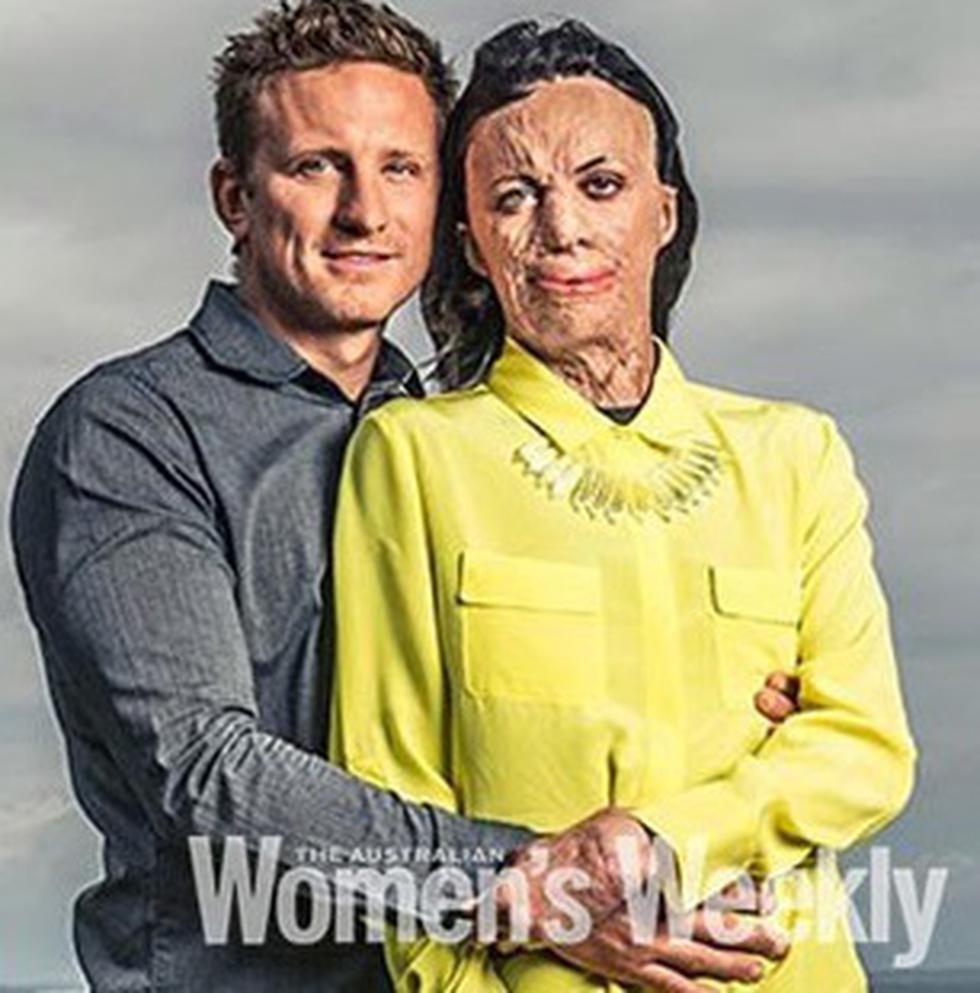 Mujer con quemaduras es elegida para portada de revista (FOTOS)