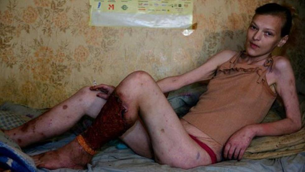 Conoce el Krokodil: la droga que pudre de adentro hacia fuera